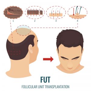 Connecticut Residents Are Likely to Get Good Results With a Hair Transplant