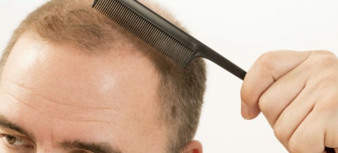 Types of Non-Surgical Hair Restoration Methods