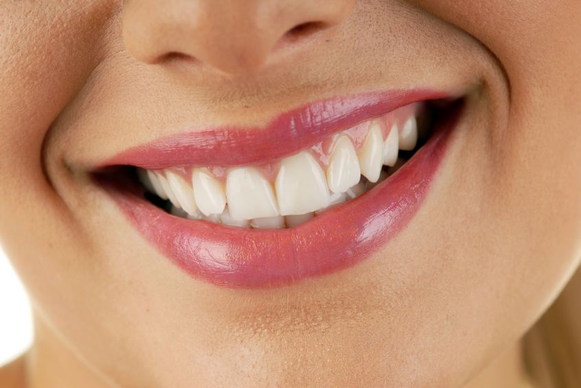 In Surrey, BC, how can Invisalign improve your smile?