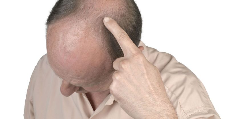 Determining If You Are a Candidate for Hair Restoration in New York City