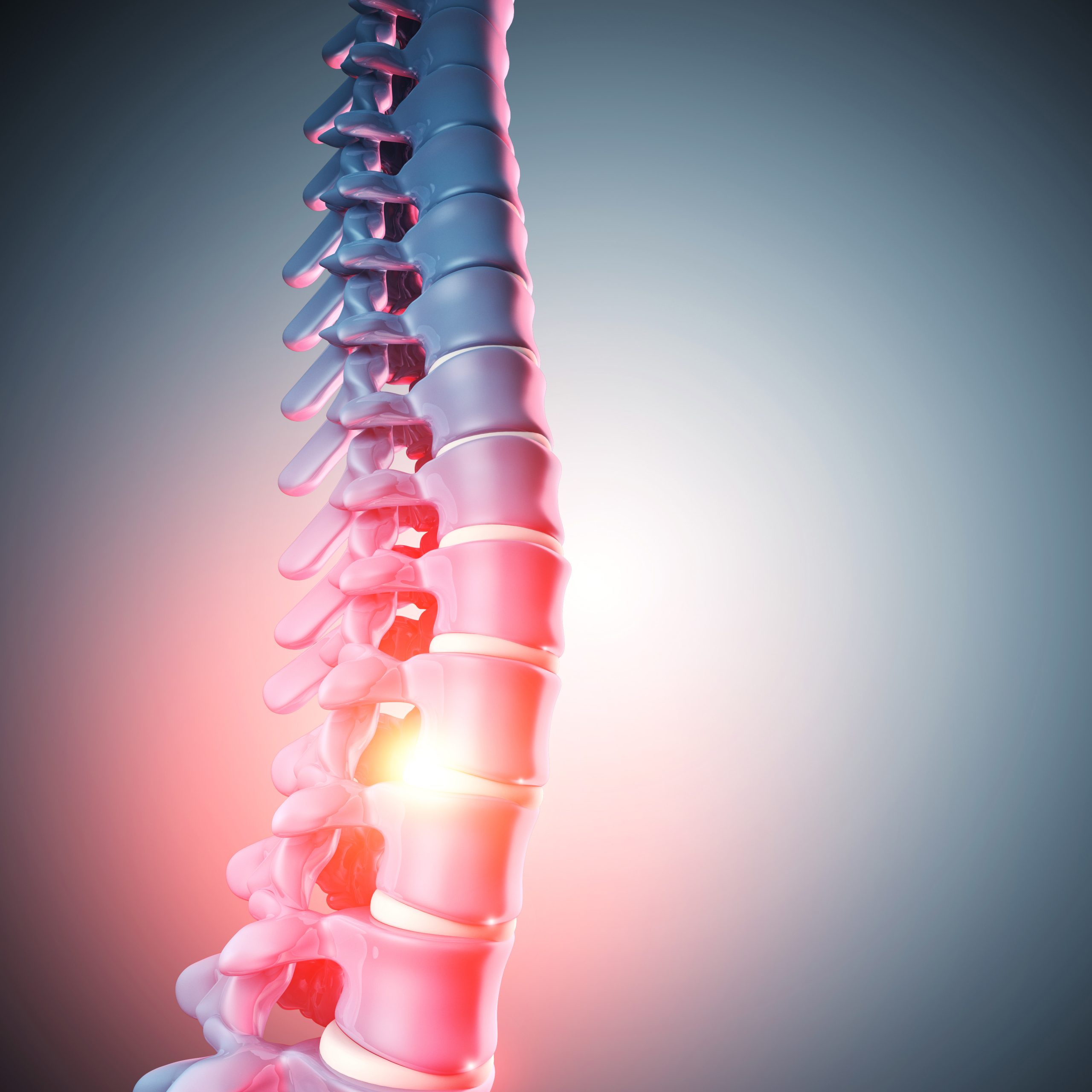 Fixing a Painful Bulging Spinal Disk in Your Back in Glendale, AZ